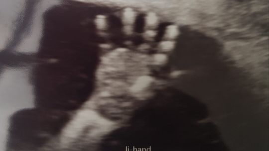 Małe serduszko Antosia Glubiaka może bić nadal tylko dzięki naszym dobrym sercom!