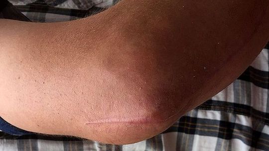 Uczennicę ze złamaniem wysłano do domu – pisze czytelniczka. Uruchomiliśmy procedurę – odpowiada dyrektor Uczennicę ze złamaniem wysłano do domu – pisze czytelniczka. Uruchomiliśmy procedurę – odpowiada dyrektor