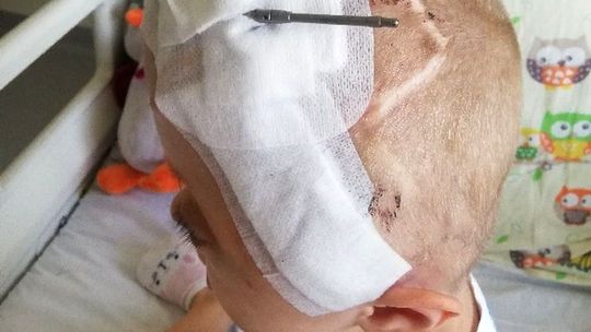 Unikalna operacja korekcji czaszki u 5-letniej Tosi. To pierwszy taki zabieg w Polsce