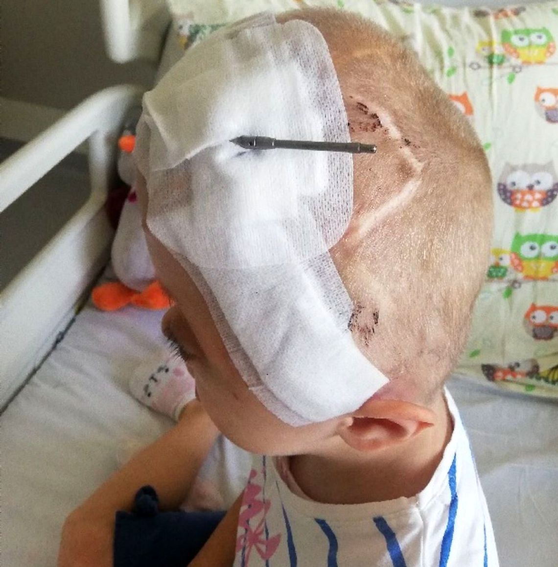 Unikalna operacja korekcji czaszki u 5-letniej Tosi. To pierwszy taki zabieg w Polsce